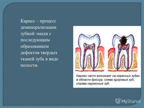 Уменьшение риска развития кариеса