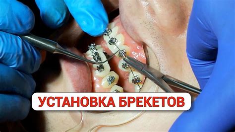Установка брекетов на верхнюю челюсть: детали и возможности