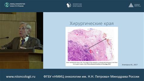 Факторы, влияющие на рецидив