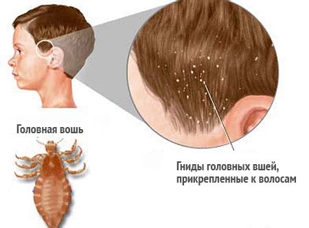 Факторы, способствующие распространению вшей на париках