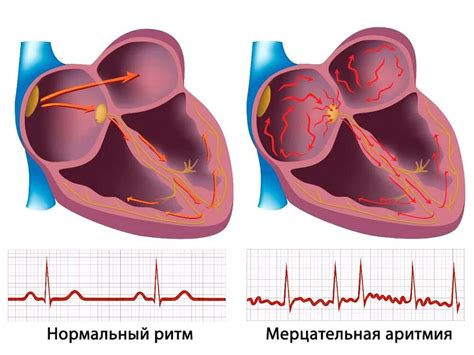 Факторы, усиливающие связь между кофе и мерцательной аритмией