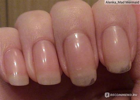 Фиксация заклеенного ногтя