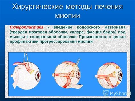 Хирургические методы лечения миопии