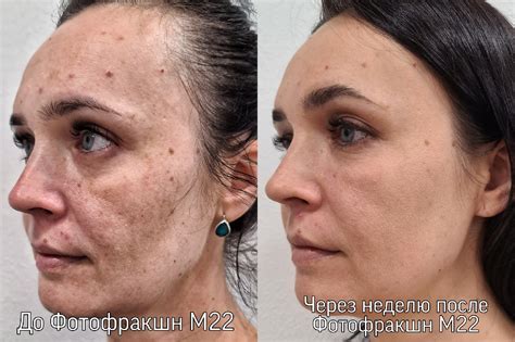 Что вызывает зуд на лице во время беременности