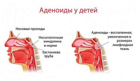 Что такое аденоиды и их функции