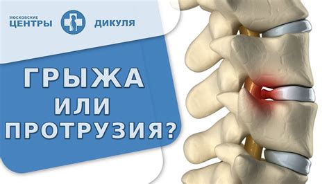 Что такое протрузия и каковы ее основные симптомы
