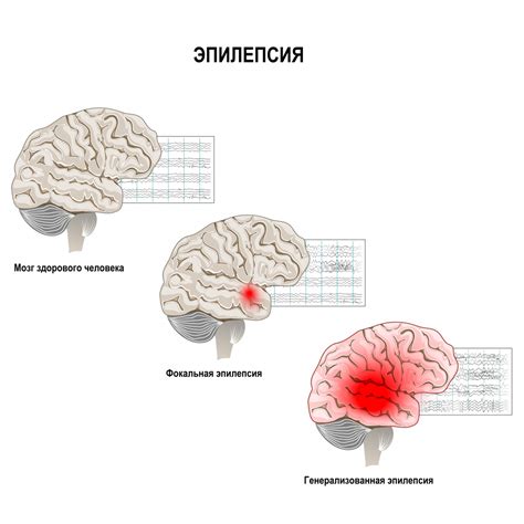 Эпилепсия у детей: выздоровление возможно