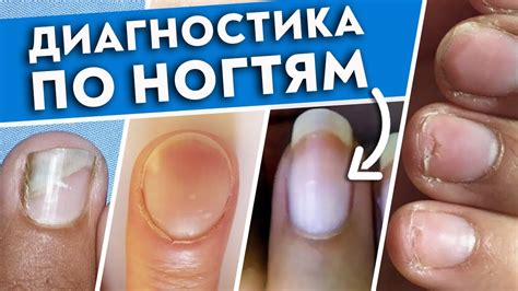 Эстетические проблемы при грызении ногтей