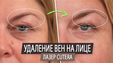  Методы удаления вены 