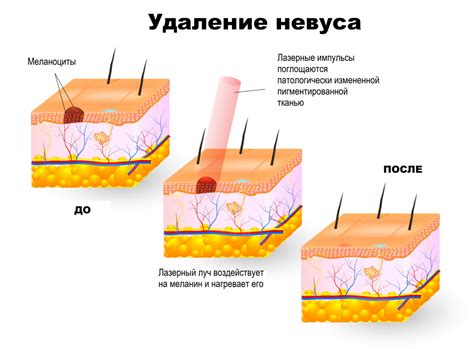  Природа родинки 