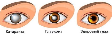  Симптомы катаракты и глаукомы 
